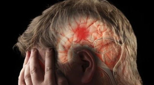 gejala dari mini stroke