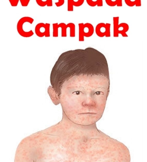 Antisipasi Virus Penyakit Campak Adalah Program Setiap Bulan Dinkes Bolmut